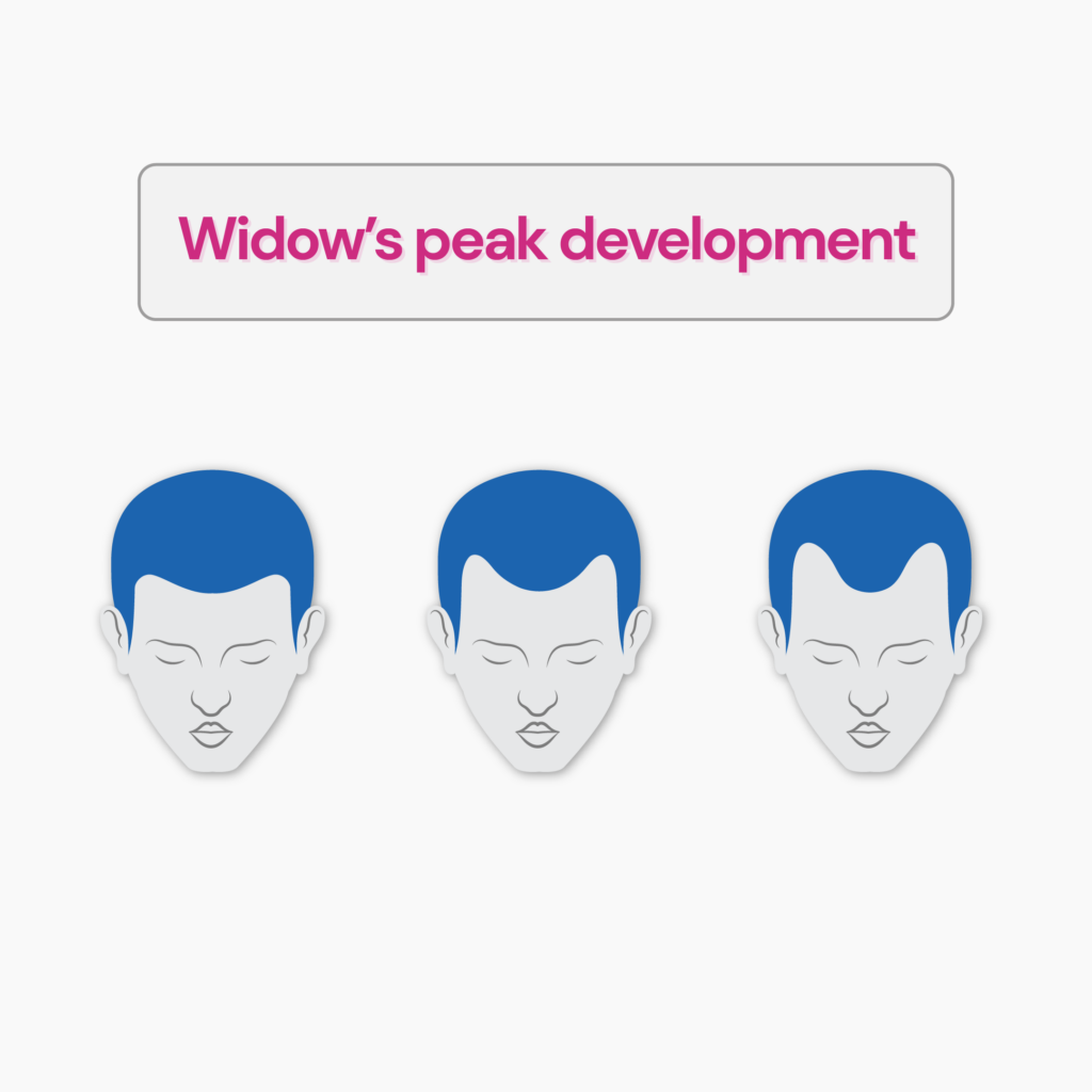 Widow's peak development. The hair starts to recede from the temples of the head and hairline goes inward, resulting in a V-like peak.