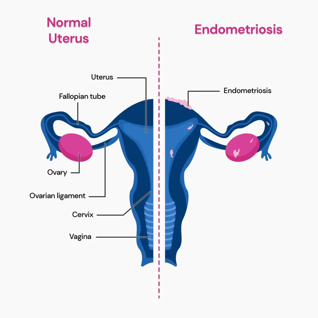 An image depicting normal uterus vs. endometriosis.