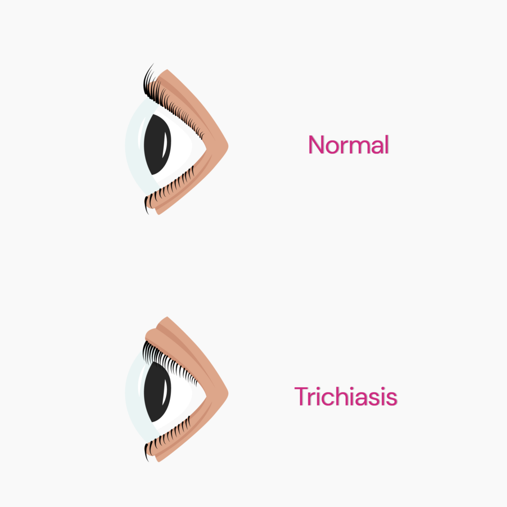 Image showing a caricature of trichiasis vs normal eye