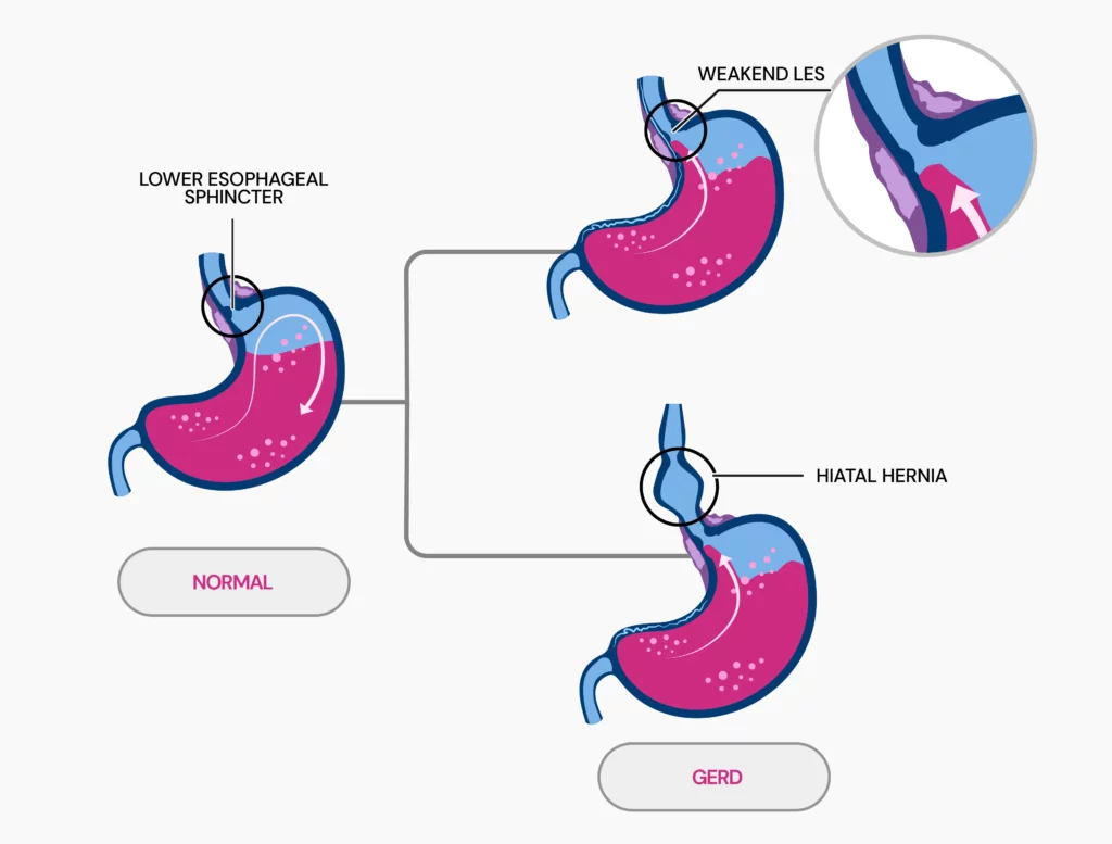 Normal vs GERD: The image shows the difference in how stomach acid is contained in normal vs GERD scenarios. Normally, the lower esophageal sphincter closes to prevent acid from the stomach regurgitating back to the esophagus. In case of GERD, due to weakened muscles, the sphincter doesn't close and acid goes back to the esophagus. Or in case of hiatal hernia, the stomach gets pushed up through a weakness in the diaphragm. 